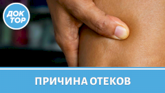 Как отличить отёк от почек и от щитовидки?