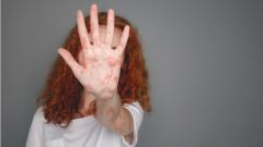 Вирусологи выяснили, когда на Земле появилась корь