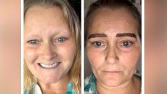 Микроблейдинг обернулся для женщины серьезным воспалением