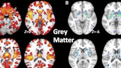Выявлен новый «незаметный» тип шизофрении