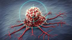 радиоактивный имплантат, эффективно уничтожающий рак