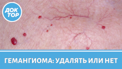 Главные правила профилактики гемангиом