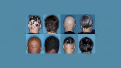 Препарат от артрита успешно применили при лечении выпадения волос