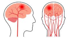 В Подмосковье врачи спасли женщину в внутримозговой гематомой в 60 мл