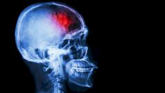 Инсульт: как распознать, кто в группе риска