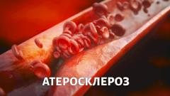 Атеросклероз