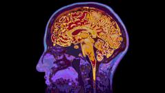 В Подмосковье врачи спасли 16-летнюю девушку с инсультом