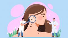 Как следить за родинками, или Профилактика меланомы