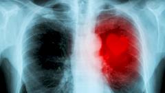 Искусственный интеллект научили предсказывать инфаркт или инсульт