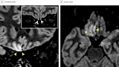 Вирус SARS-CoV-2 может влиять на белое вещество головного мозга