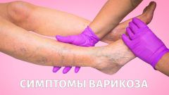 Варикоз