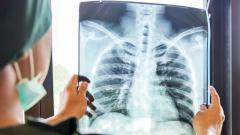 Заболеваемость туберкулезом в России снизилась до исторического минимума