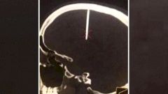 Находки Доктора: гвоздь в голове, памятник Склифосовскому и вред от сна на животе