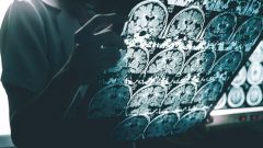 Влияние COVID-19 на мозг оказалось схоже с болезнью Альцгеймера