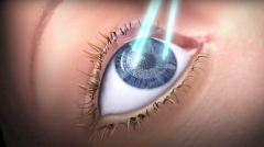 Лазерная коррекция