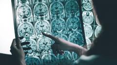 Найдена редкая агрессивная форма болезни Альцгеймера. Она поражает людей в возрасте до 45 лет