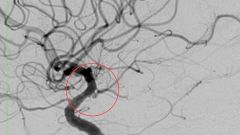 Врачи спасли пациентку с аневризмой, не вскрывая череп